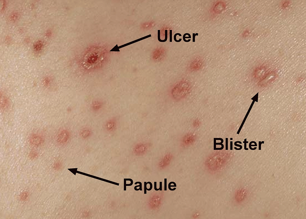 chicken pox rash pictures early stages