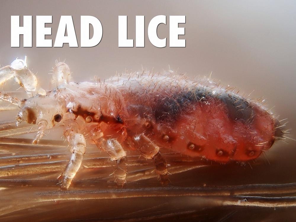 Beware of Head Lice