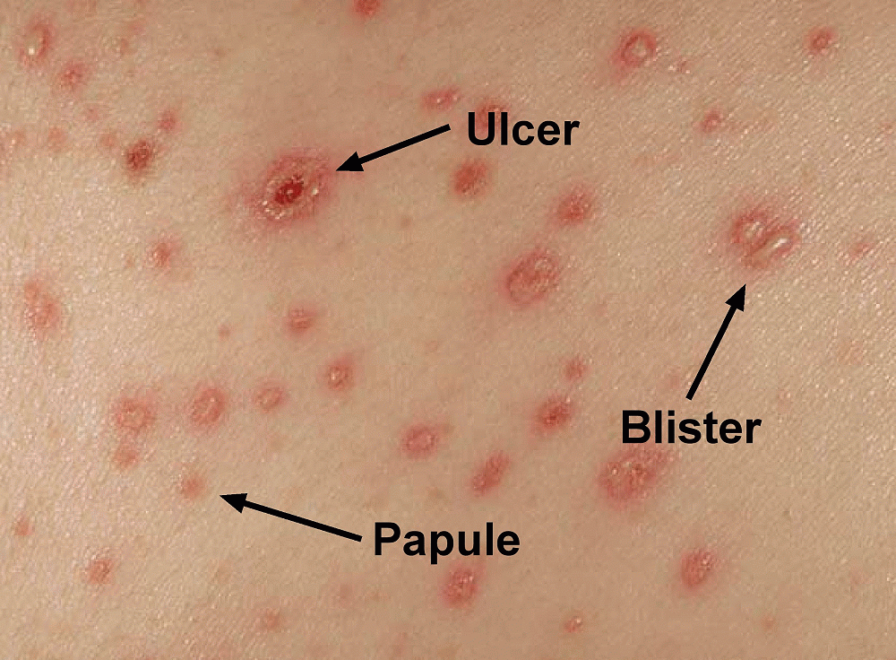 Chicken Pox Notification Newsletter 21 March 19