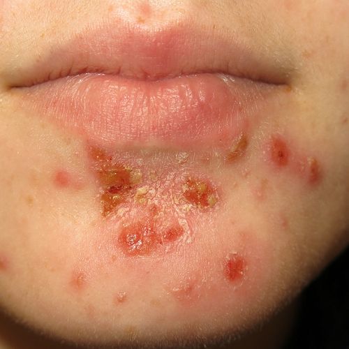 Impetigo