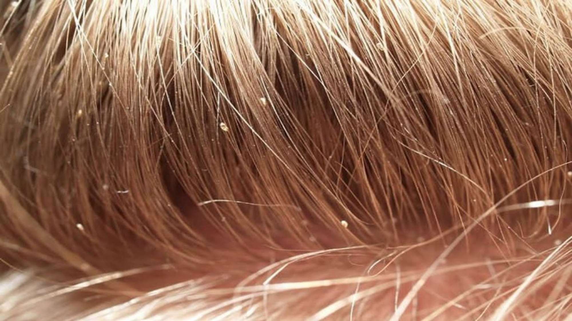 Head Lice Have Been Reported