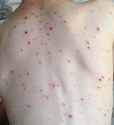 Chickenpox