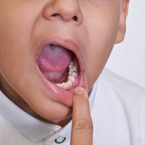 Checking children's teeth for caries