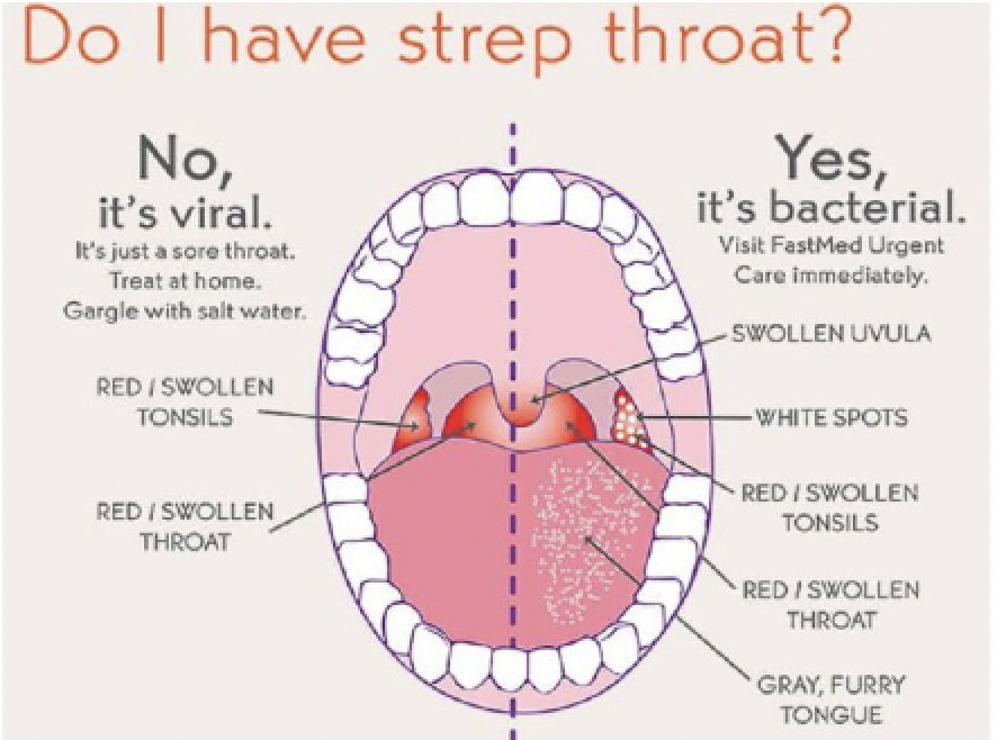 Will Tonsillitis Show Up On A Strep Test